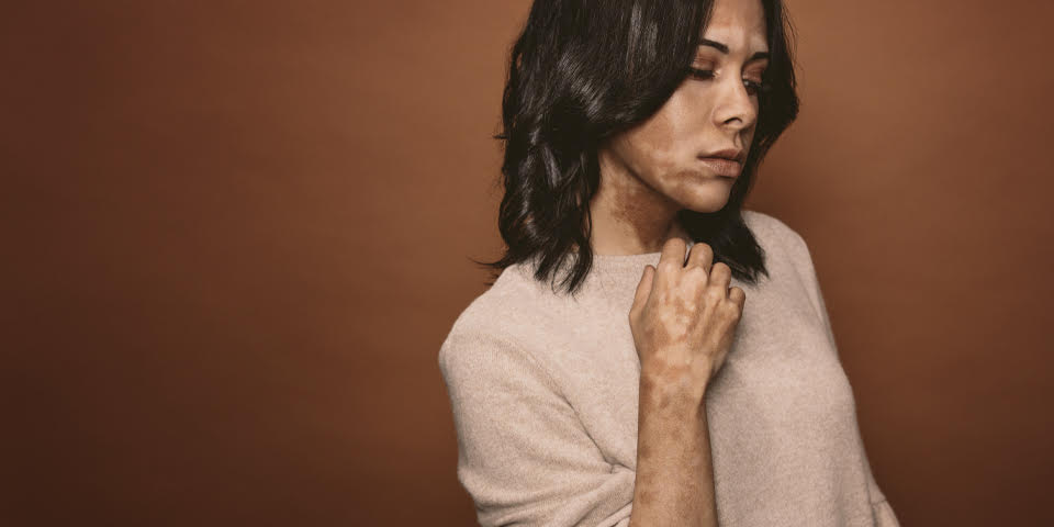 The vitiligo thyroid connection